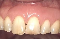 Gingivaepithesen